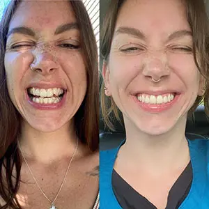 invisalign-before-after-1