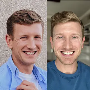 invisalign-before-after-4