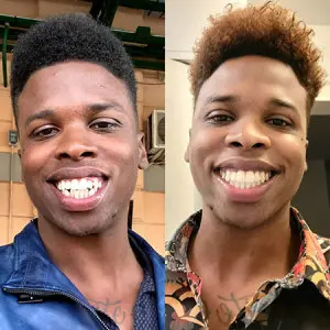 invisalign-before-after-5