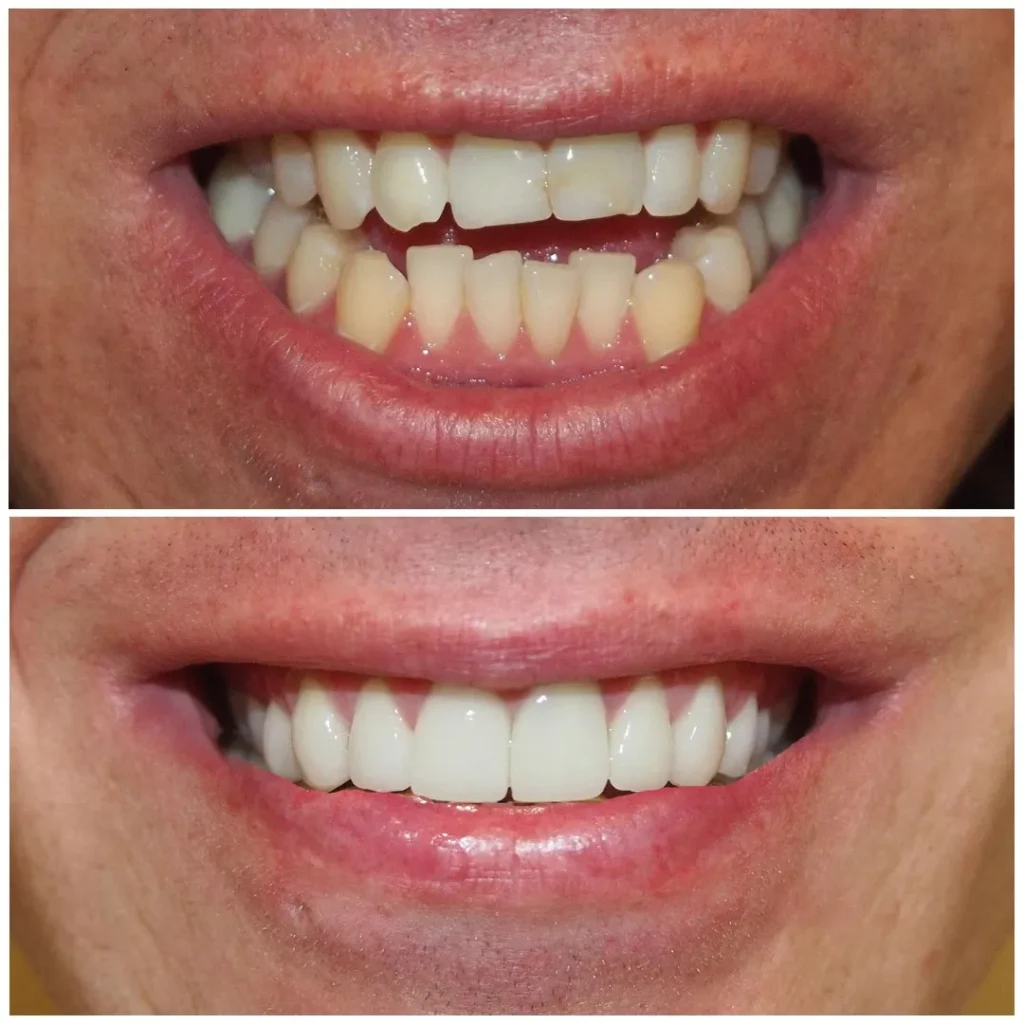 veneer before and after 1