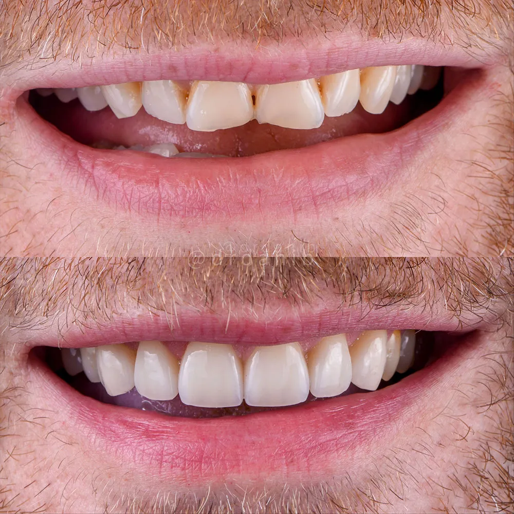 veneer before and after 2