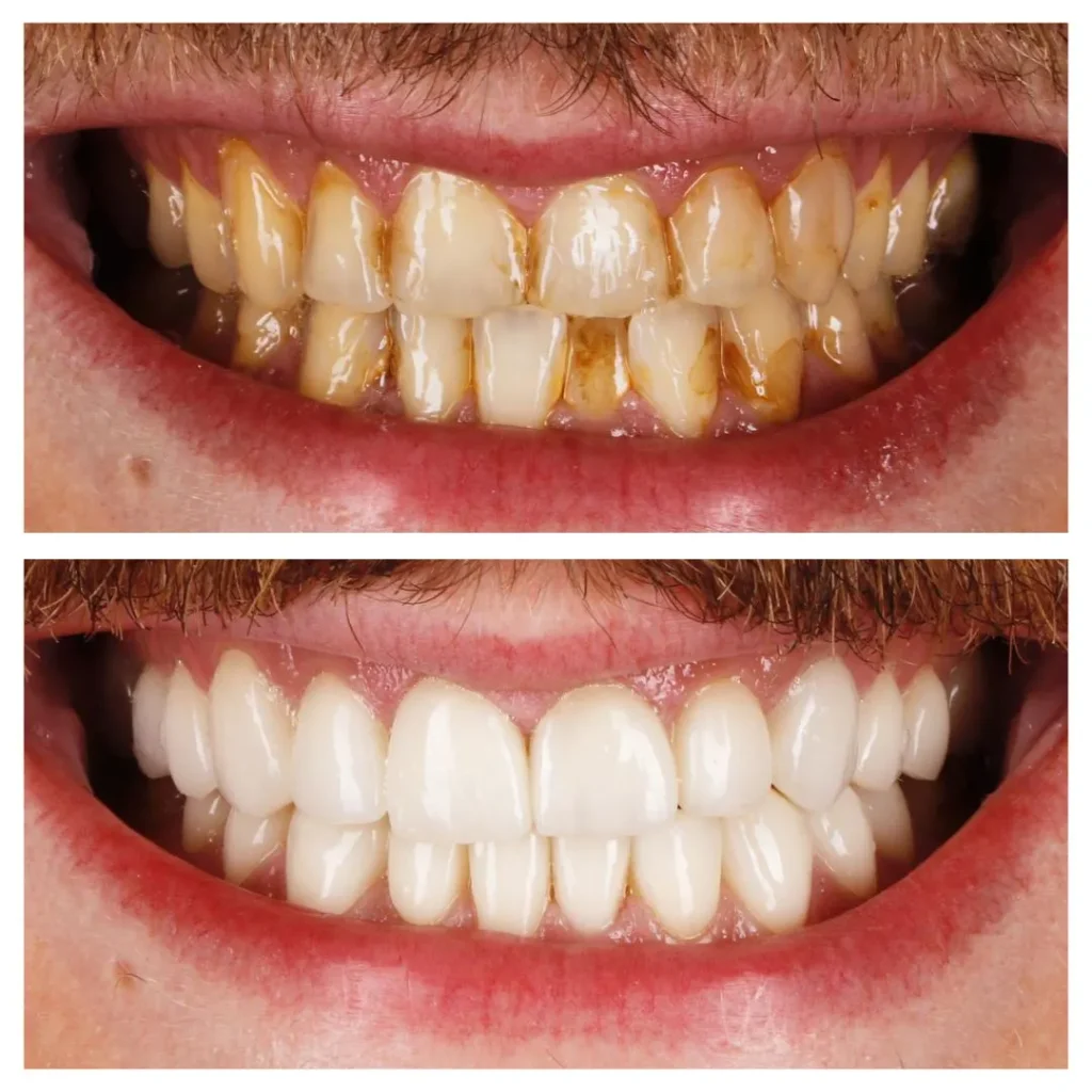 veneer before and after 3