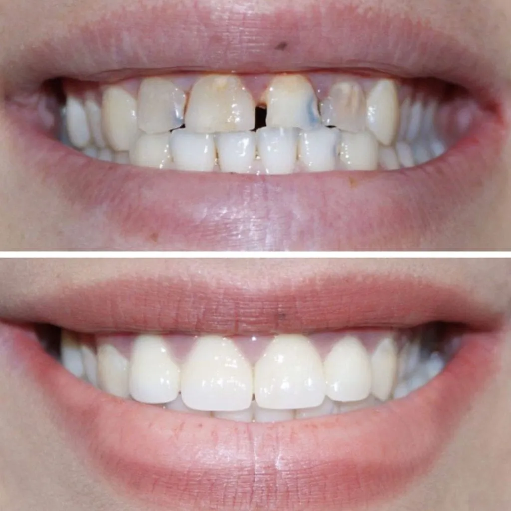 veneer before and after 4