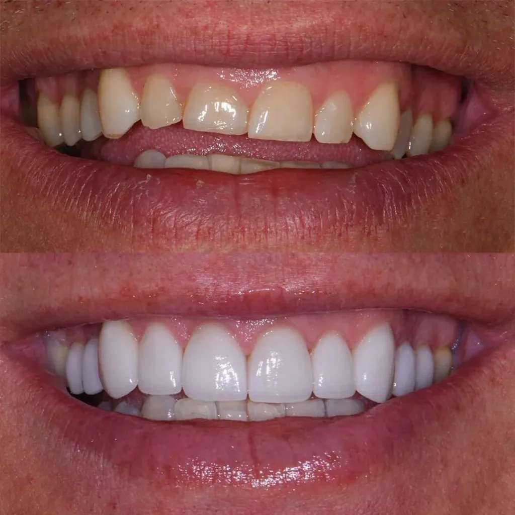 veneer before and after 5