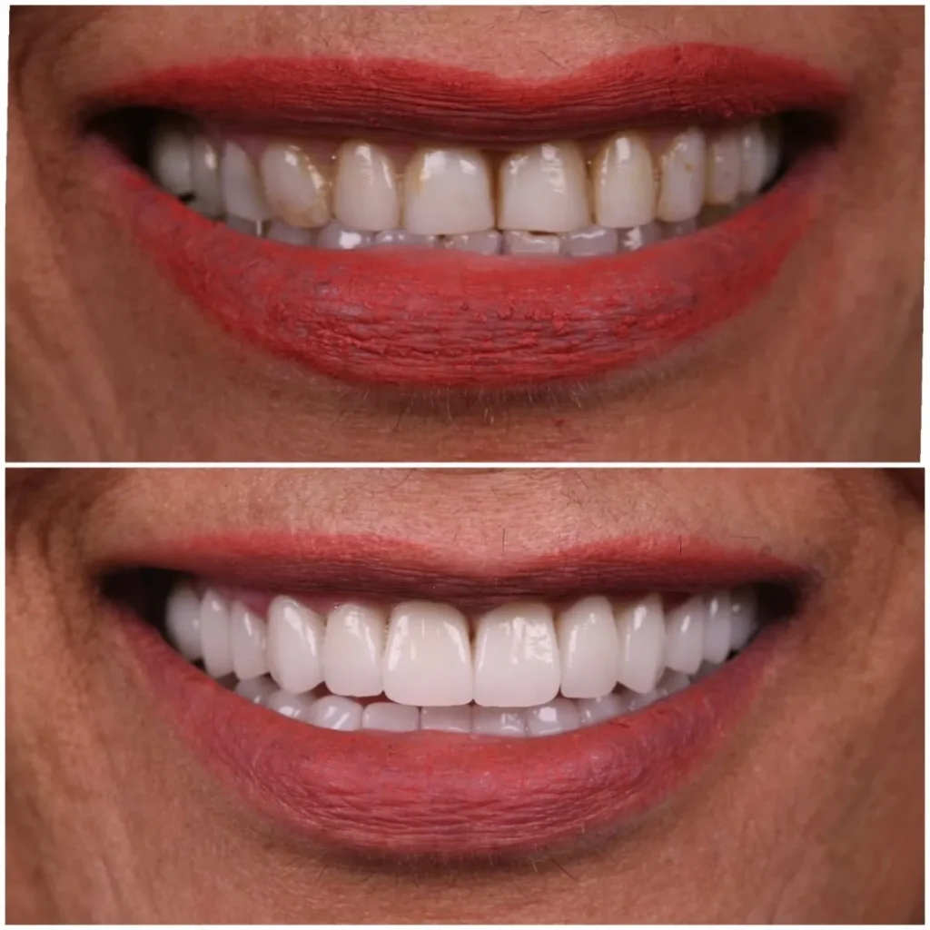 veneer before and after 6